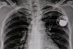 Pacemaker